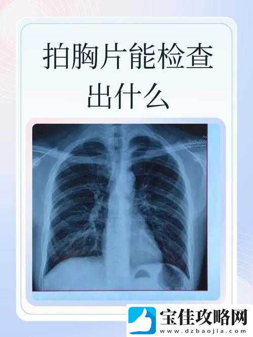 胸片